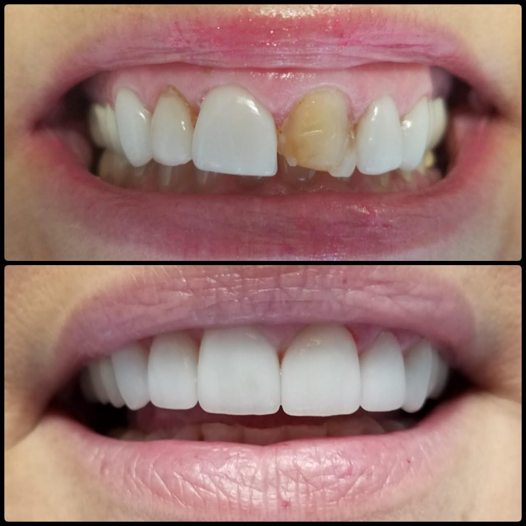 Veneers 1024x1024 - Gallery