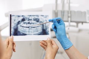 dentist showing x ray image to patient 300x200 - Let Us Explain Your Dental Benefits